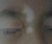 确诊儿童白癜风,需要做哪些检查?